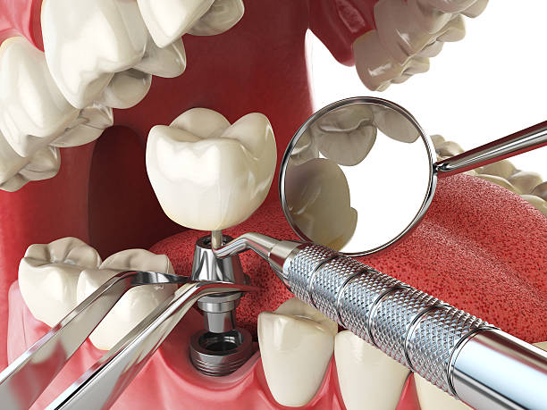 Best Emergency Treatment for Oral Infections in Cheyenne, WY